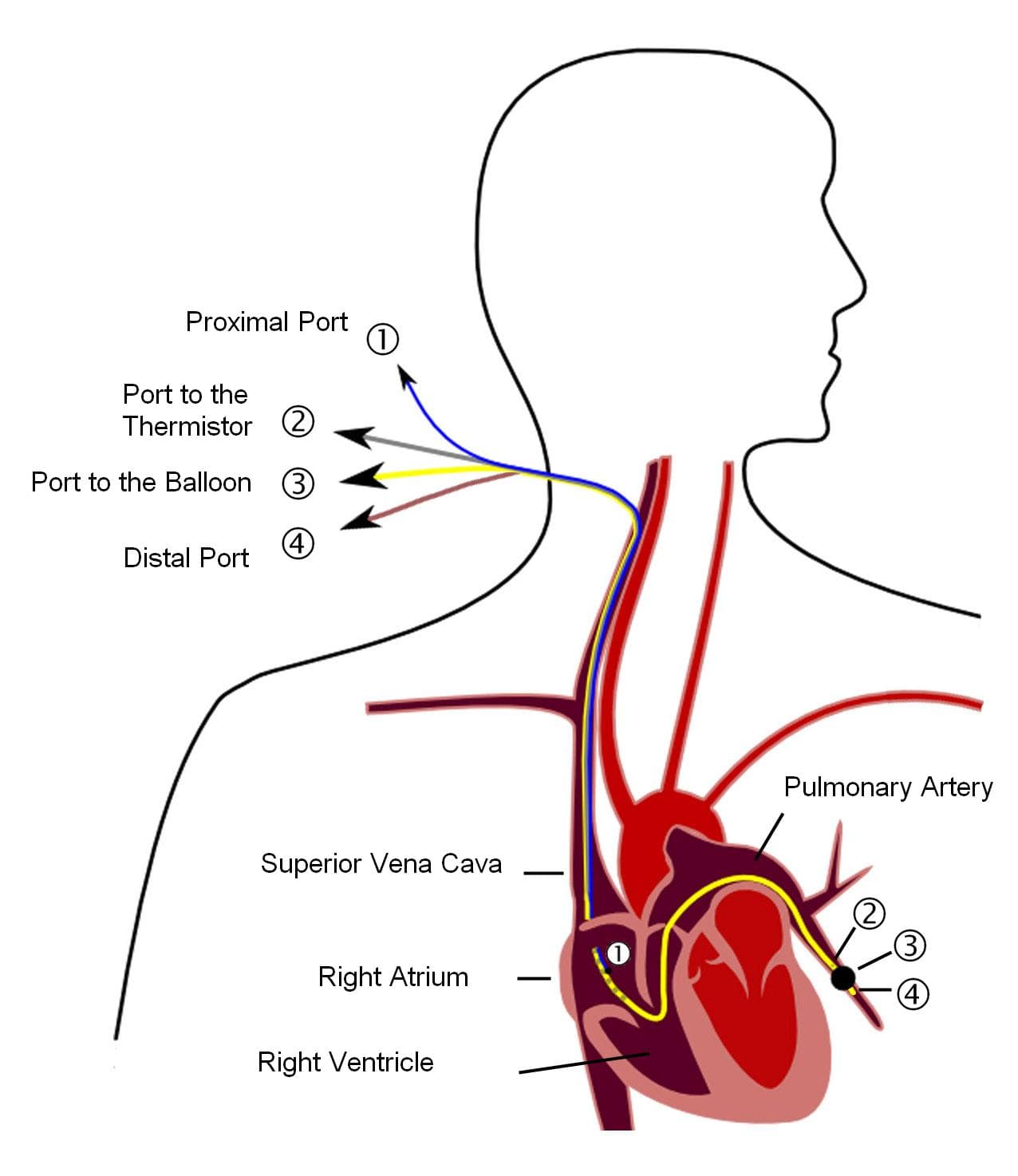 Pulmonary artery catheter - Wikipedia