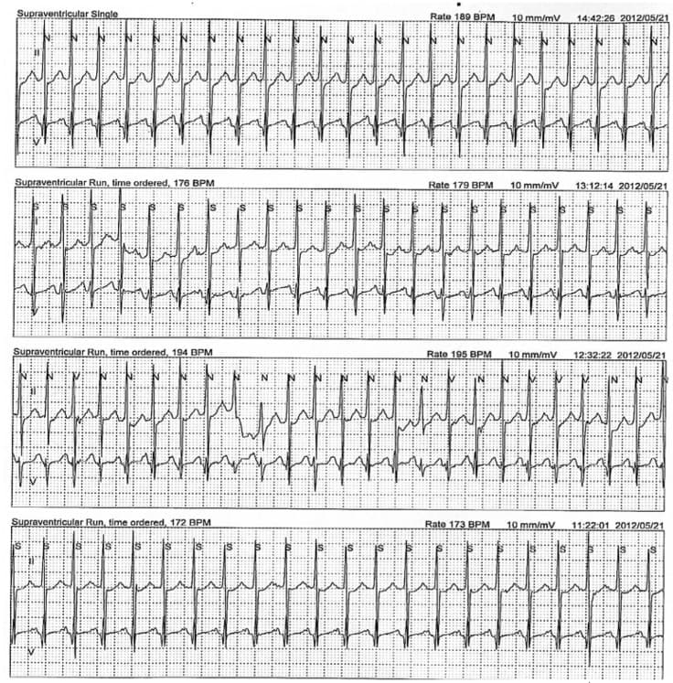 Atrial tachycardia - Wikipedia