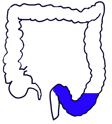Sigmoid colon - Wikipedia