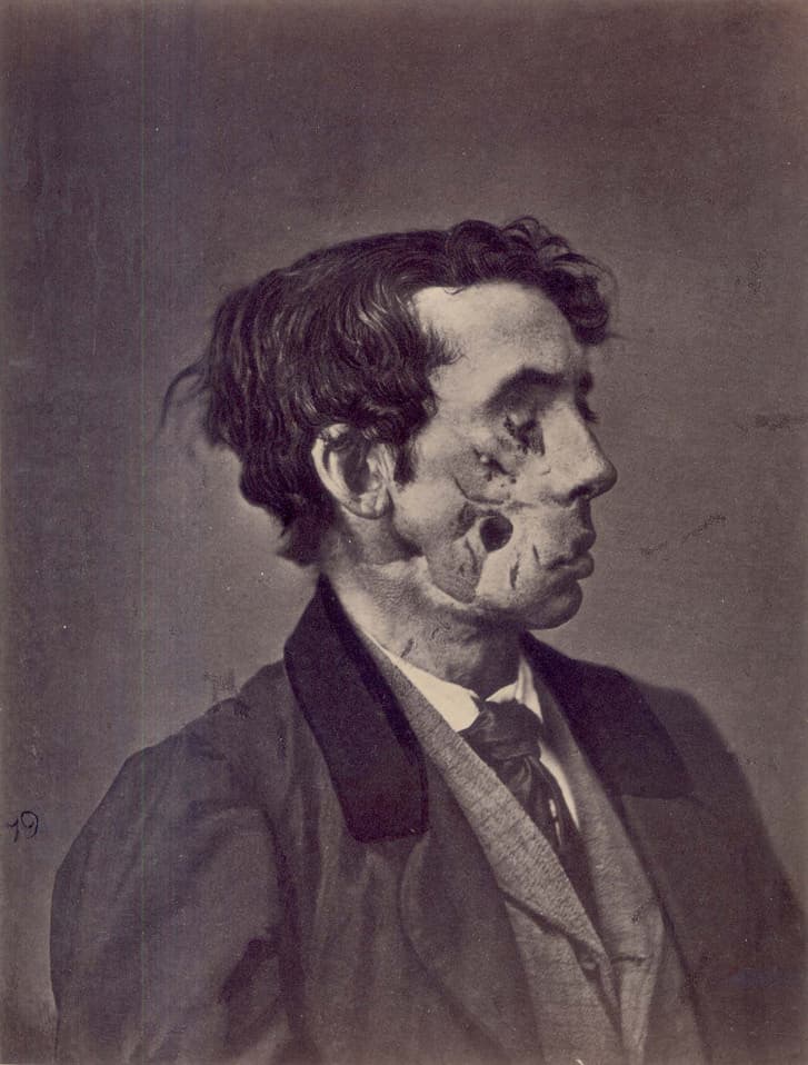 Facial trauma - Wikipedia