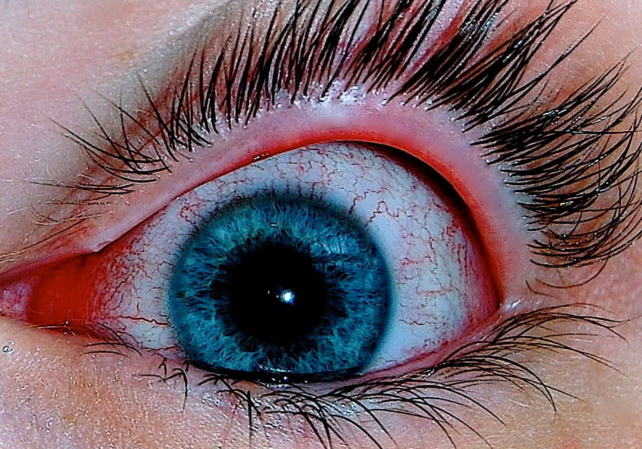 Conjunctivitis - Wikipedia
