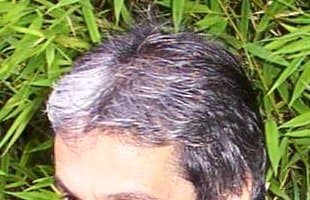 Piébaldisme — Wikipédia