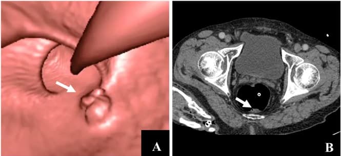 Virtual colonoscopy - Wikipedia