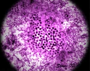 Fièvre du Nil occidental — Wikipédia