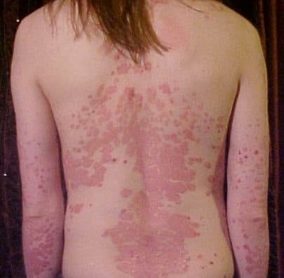Psoriasis - Wikipedia
