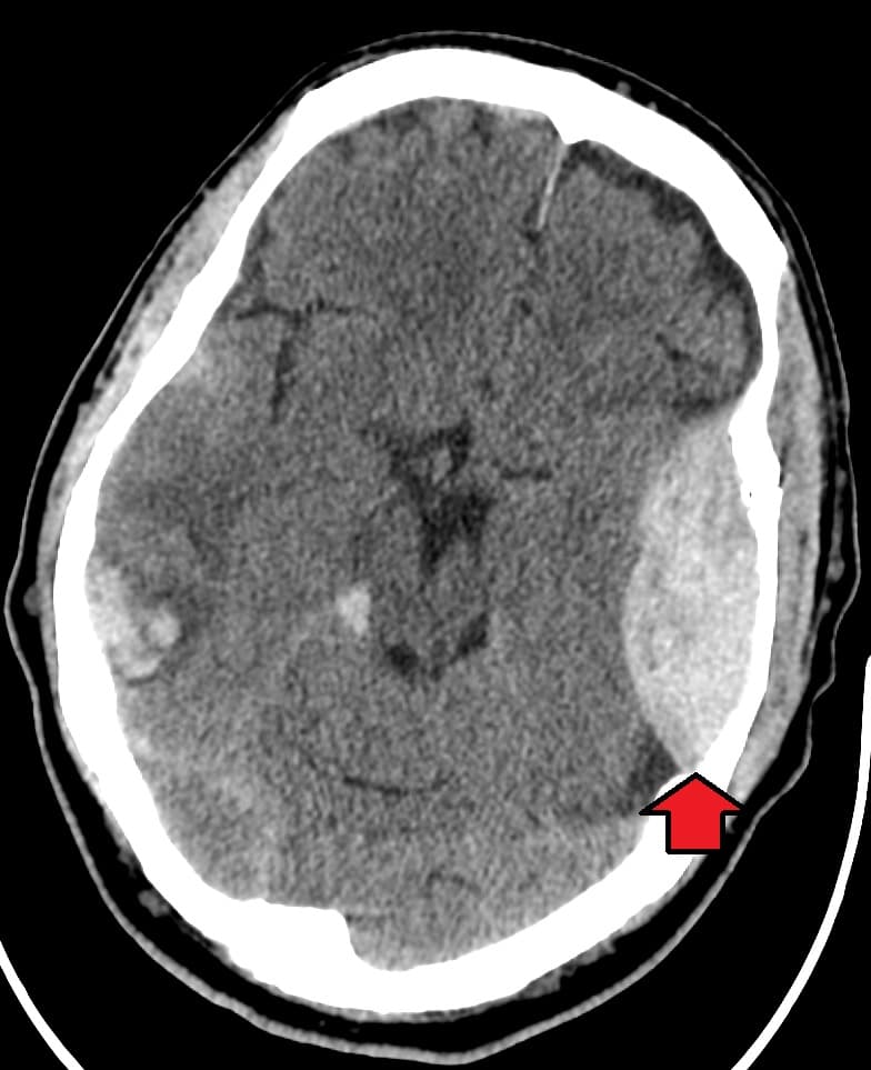 Epidural hematoma - Wikipedia