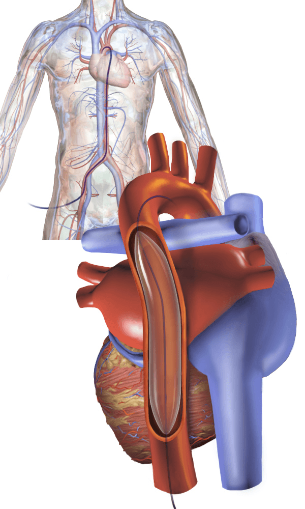 Intra-aortic balloon pump - Wikipedia