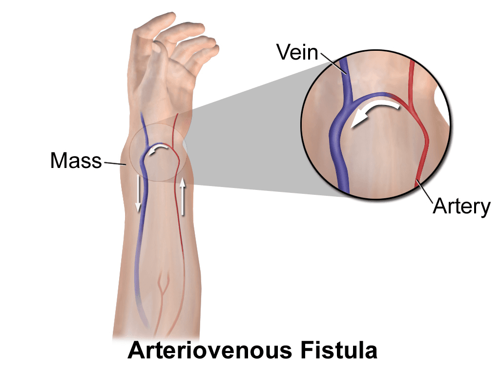 Fistule artério-veineuse — Wikipédia
