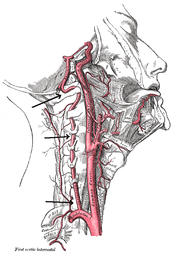 Vertebral artery dissection - Wikipedia