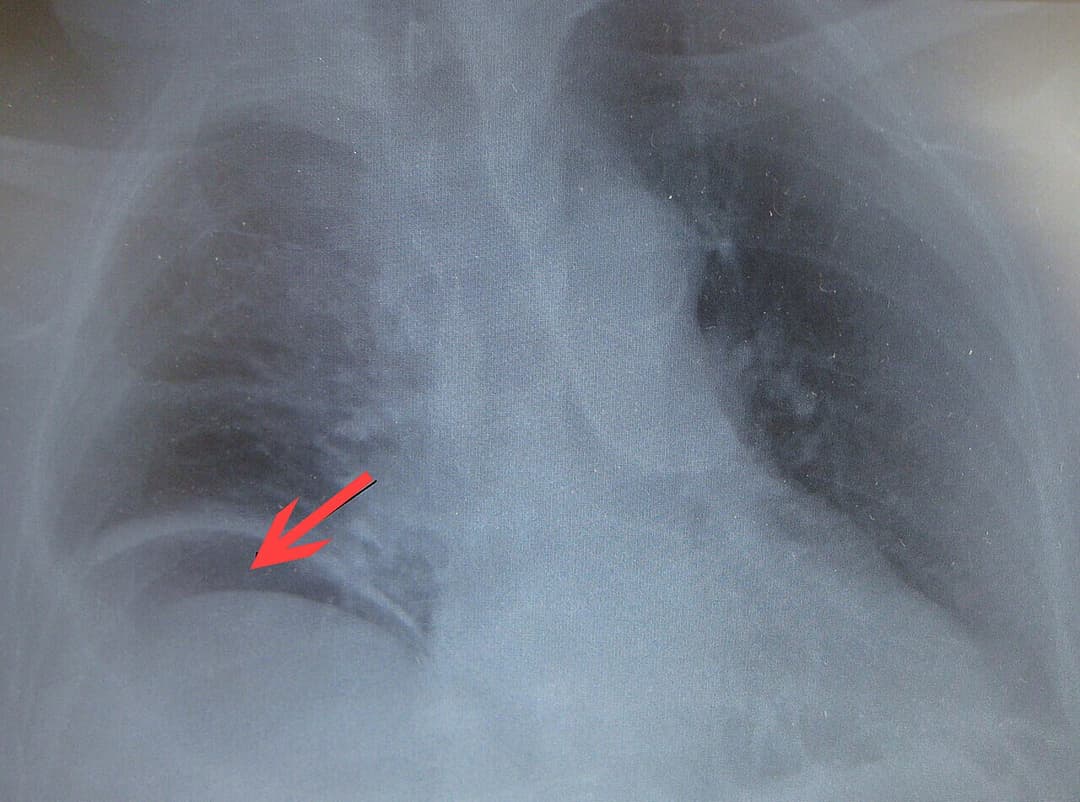 Perforation gastro-intestinale — Wikipédia