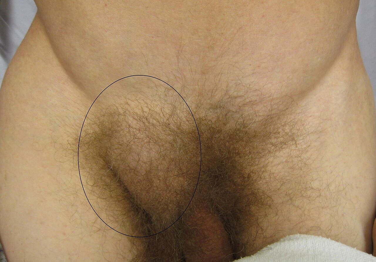 Hernie inguinale — Wikipédia