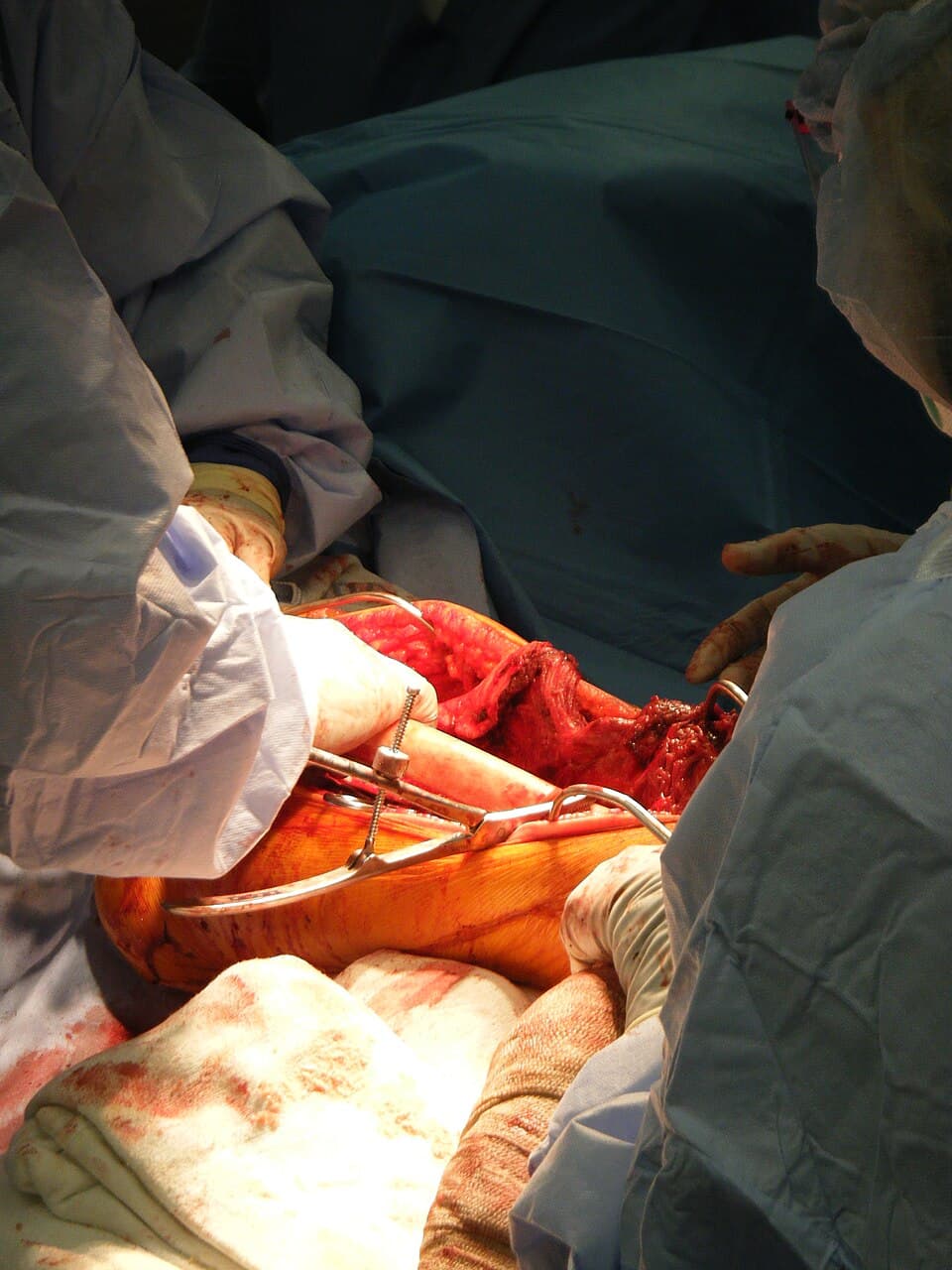 Bone grafting - Wikipedia