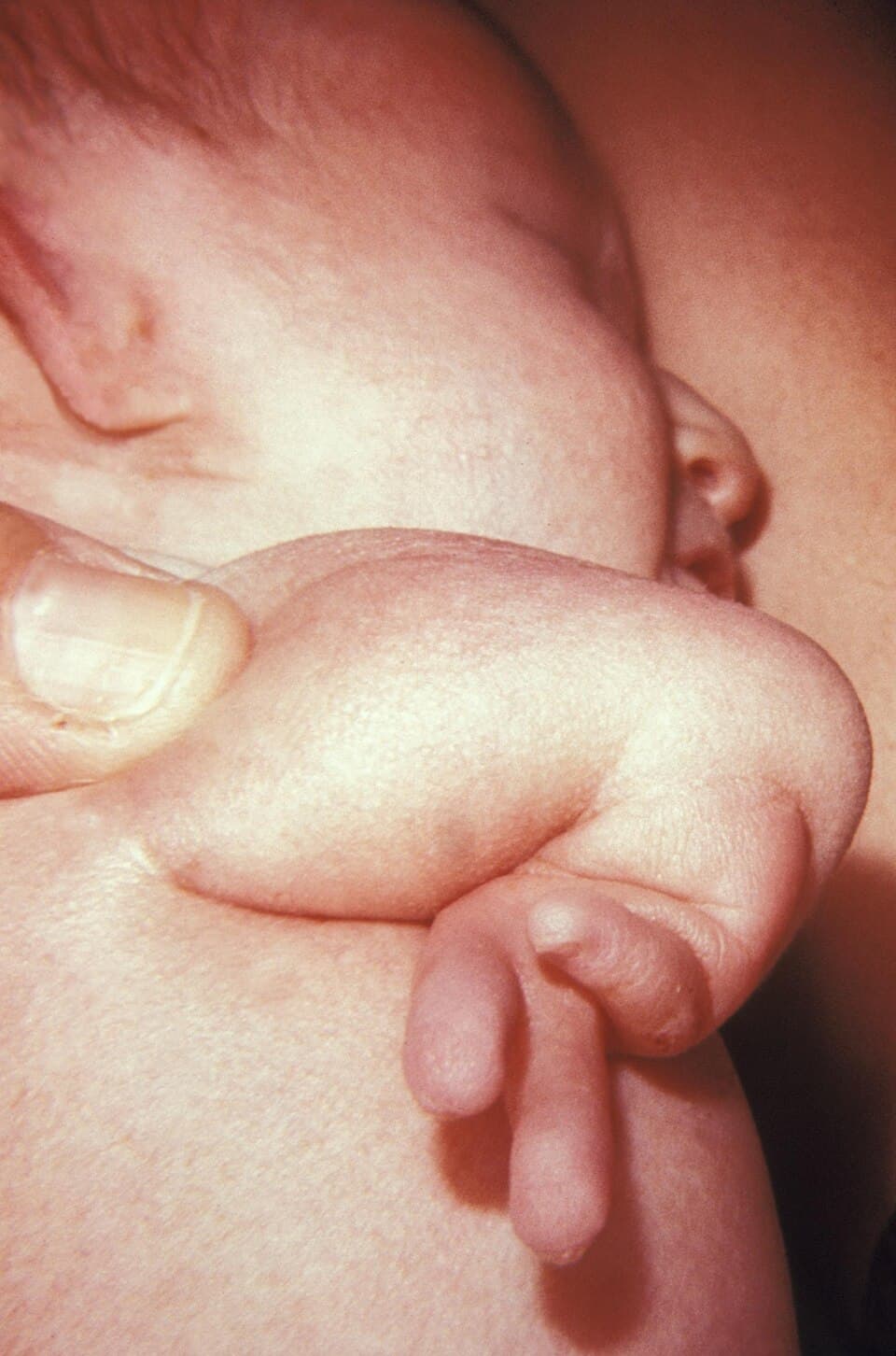 Syndrome de VACTERL — Wikipédia