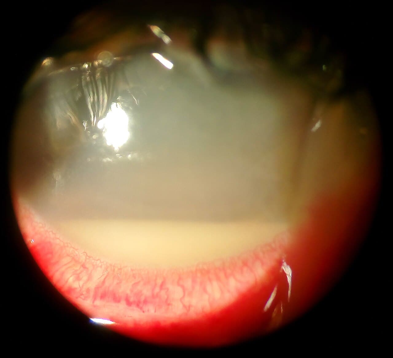 Endophthalmitis - Wikipedia