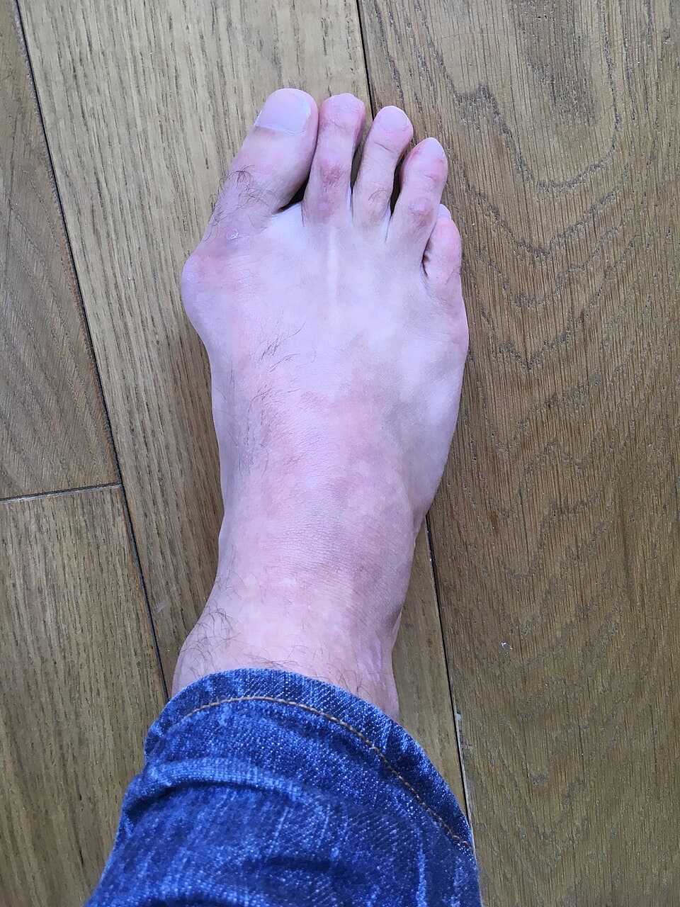 Hallux valgus — Wikipédia