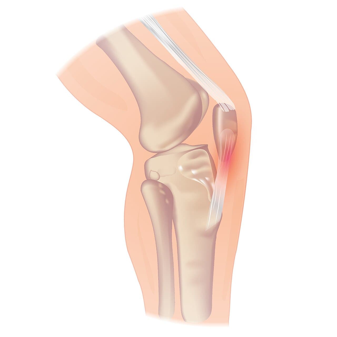 Tendinopathie patellaire — Wikipédia