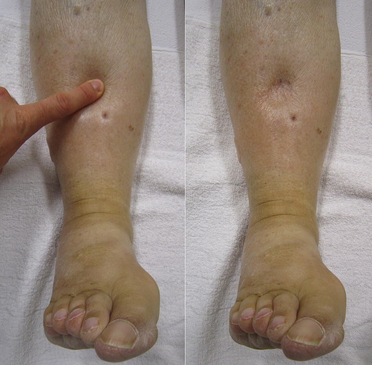 Edema - Wikipedia