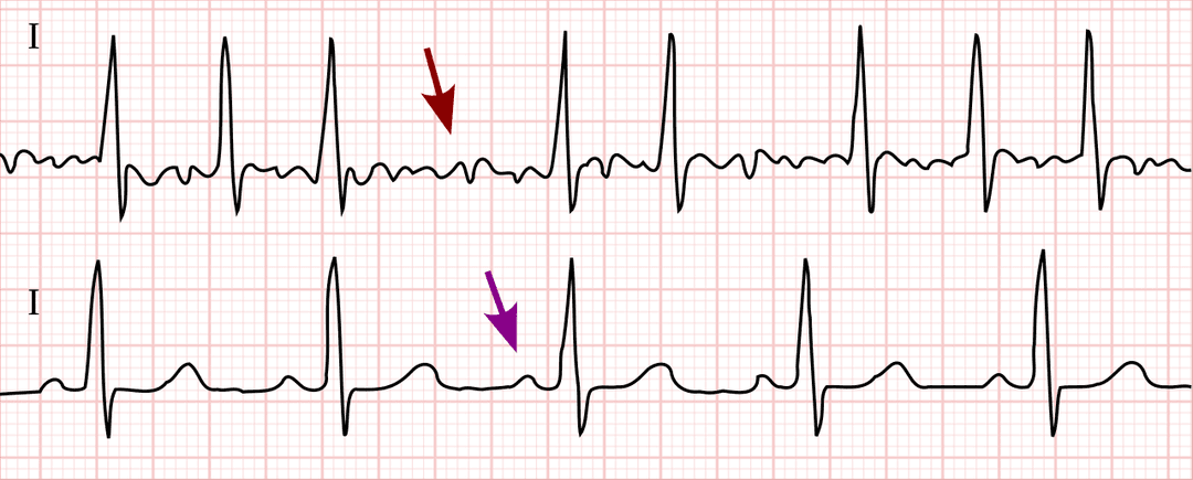 Atrial fibrillation - Wikipedia