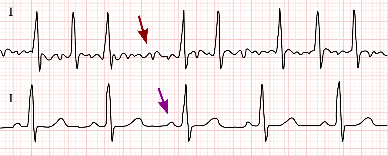 Atrial fibrillation - Wikipedia