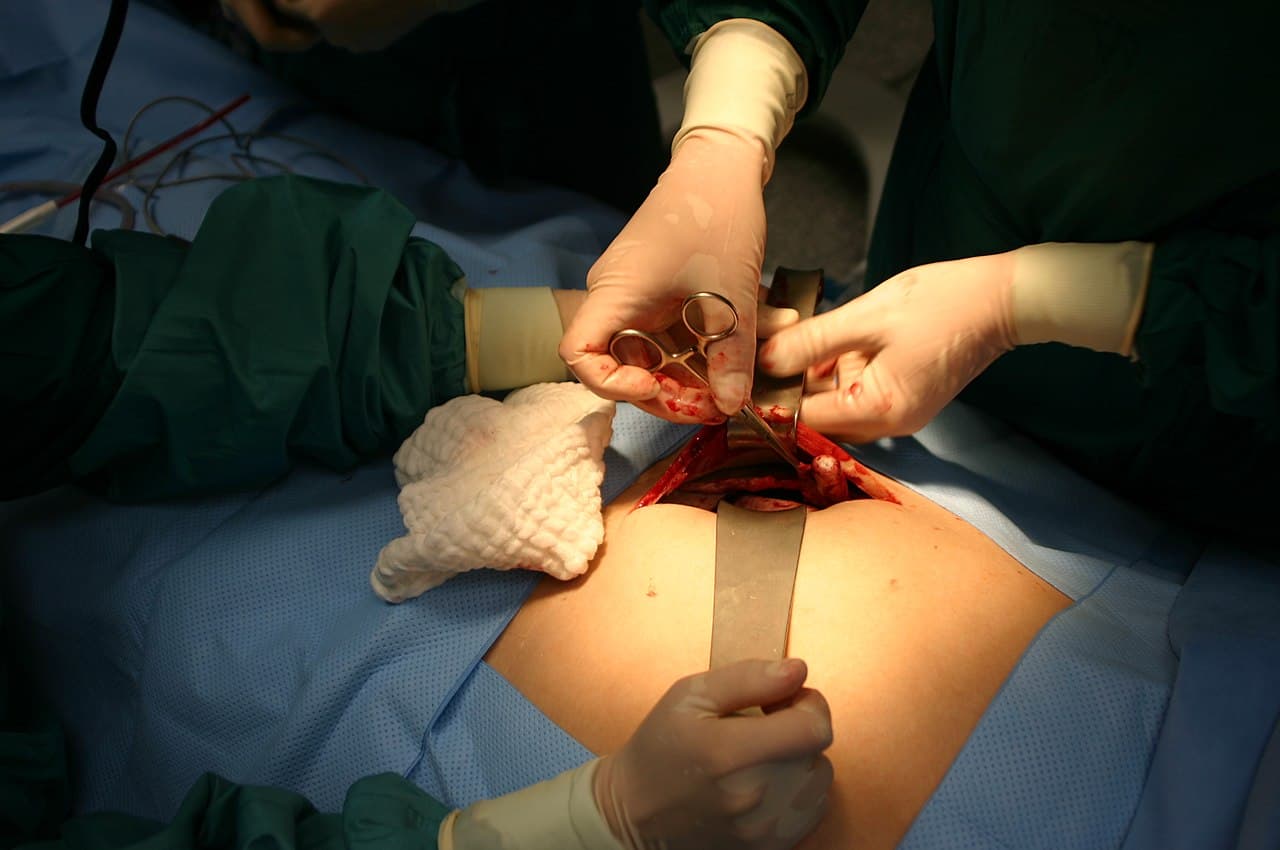 Appendectomy - Wikipedia